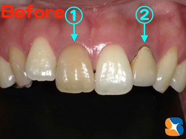 神経がないと前歯が変色