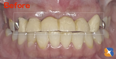 ６連結の前歯のブリッジ