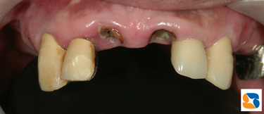 前歯の根が割れる