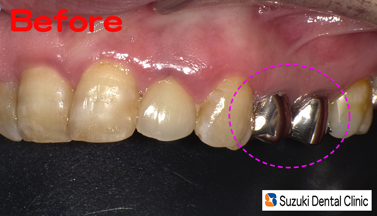 奥歯の銀歯を保険で白く出来る
