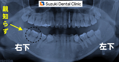 親知らずの横の歯が大きな虫歯