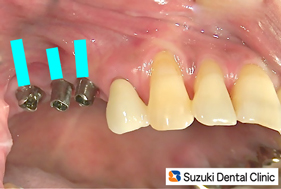 上の奥歯にインプラント３本