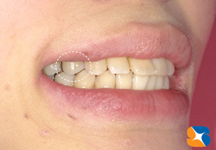 白色と銀色では大違い