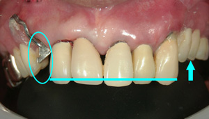 さし歯が抜けて、入れ歯が落ちる