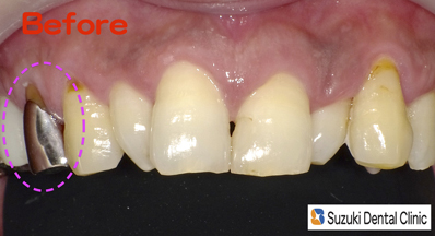 念願の奥歯の保険認可