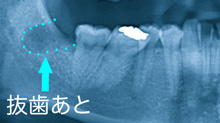 抜歯後 傷口 溶ける糸の使用 抜歯後 傷口 溶ける糸の使用