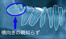 横向き　親知らず　抜歯前　