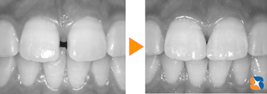 前歯のすき間を埋めるイメージ