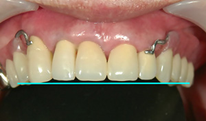 新しく完成した前歯と部分入れ歯