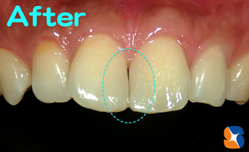保険の材料レジンで隙間を埋める