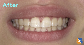 保険の樹脂の材料ですき間を埋める