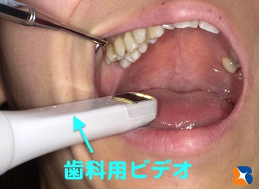 虫歯をビデオでチェック。患者様にも確認