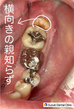 横向きの親知らず
