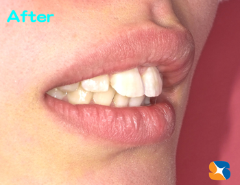 自然で違和感のない前歯に変身