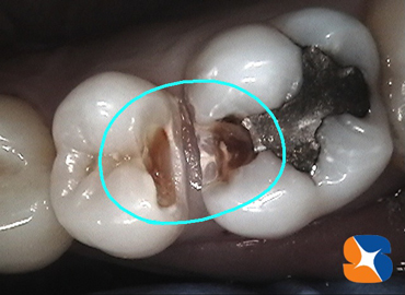 虫歯を如何にして伝えるか