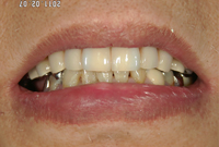 インプラント治療後の口元