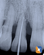 歯の根を支える骨が溶けてなくなる