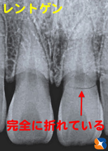 骨折をレントゲンで確認