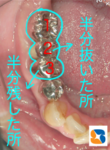 歯が半分になってもしっかり噛める