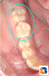 シーラント　白い詰め物　保険