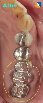削る歯の本数を最小限に抑える