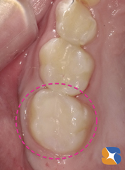 オールセラミックの詰め物を装着 オールセラミックの詰め物を装着