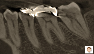 部分的なレントゲン