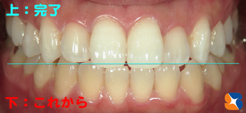 上の歯と下の歯の比較