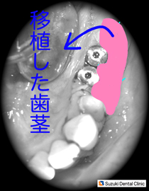 皮の厚い歯肉にかえる