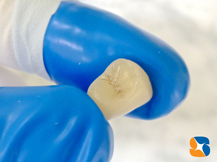 金属を使わないセラミック