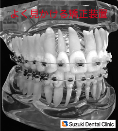 よく見かける矯正装置