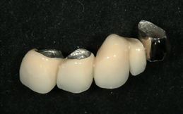 自費の５本ブリッジ