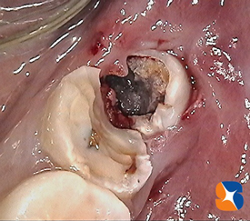 横向きに生えている親知らず