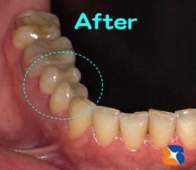 セラミックの詰め物を器械で製作