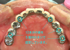 多数インプラントの構成