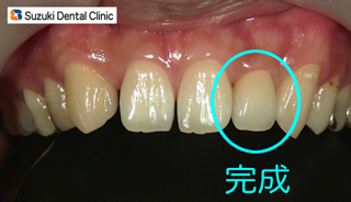 白い歯　オールセラミックス