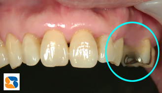 奥歯が２本ありません