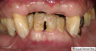 事故で前歯をなくす