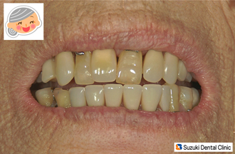 入れ歯の金具が見えなくなった