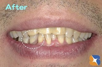 スッキリ目立たない入れ歯