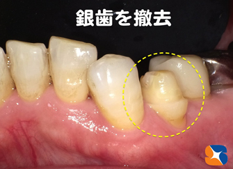 手直しを加えて型取りの準備