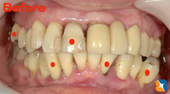 グラグラしていて噛めない