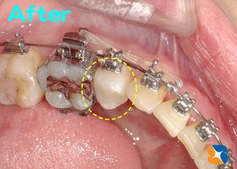 来院から僅か２時間でセラミックの詰め物が完成