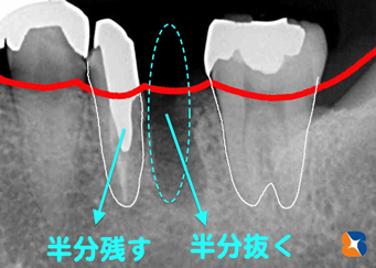 奥歯を２分割して良い方を残す