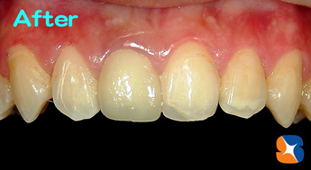 オールセラミックで修復