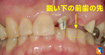 下の前歯が様々なトラブルを引き起こす