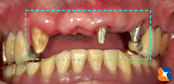 ブリッジの持ちは土台が肝心