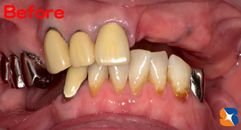 見た目も悪い、噛みにくい入れ歯