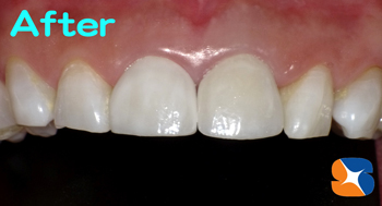 先進医療機器セレックを使用してオールセラミックを作製