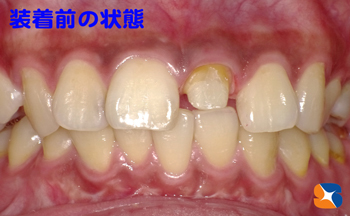 型取り前の状態